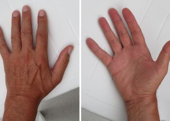 LET OP: Zien je handen er zo uit? Bel dan direct de dokter!