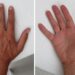 LET OP: Zien je handen er zo uit? Bel dan direct de dokter!