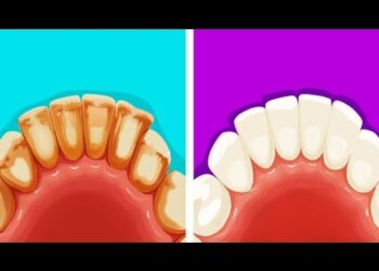 Met deze eenvoudige truc kan je zelf simpel tandplak verwijderen