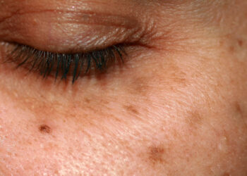 Met dit simpele huismiddeltje ben je snel van ouderdomsvlekken af