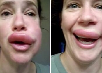 LET OP: Dit mag je nooit doen als je door een wesp bent geprikt