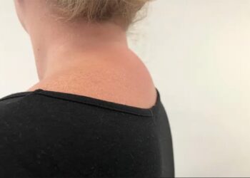 Bobbel op de achterkant van je nek? Dan kun je hier last van hebben!