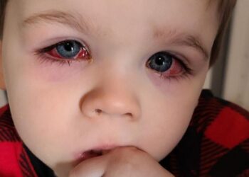 Moeder waarschuwt voor ‘onschuldig’ speelgoed waar haar kind bijna blind van werd