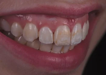 Last van aanslag op je tanden? Deze 4 tips werken echt!