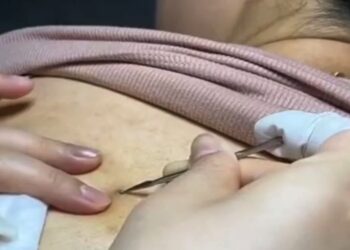 ZIEN: Jaren oude mee-eter wordt uitgeknepen