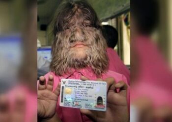 Het ‘harigste meisje ter wereld’ besloot het gezichtshaar te verwijderen. (Dit is het resultaat!)