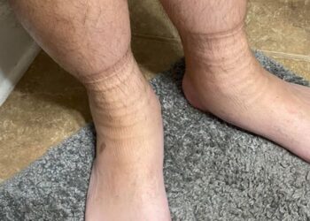 Strepen in je benen staan van je sokken in de avond? Dit is de oorzaak!