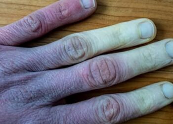 Wat te doen als je vingers wit worden in de winter?