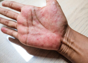 Dit is waarom je in de winter meer last kan krijgen van eczeem!