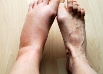 Houd jij veel vocht vast? Deze aanpassing in je eetpatroon helpt