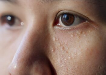 Heb jij deze witte bultjes op je gezicht? Probeer ze dan niet te verwijderen!