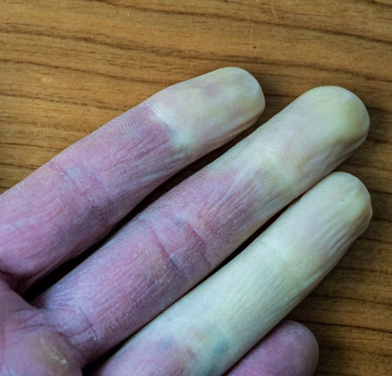 Artsen waarschuwen: Dit moet je weten als je vingers van kleur veranderen