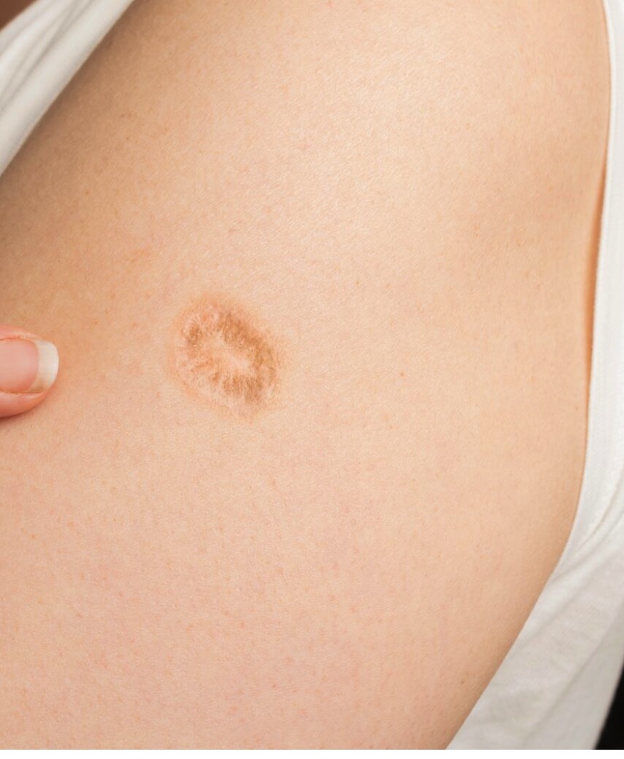 Dit is de waarheid achter dit litteken op de linkerbovenarm