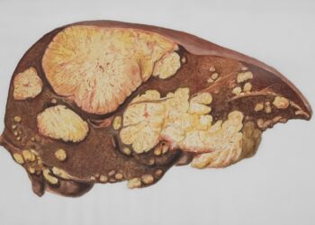 Let op: Dit is het meest voorkomende teken van levervetting