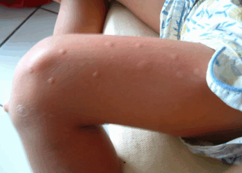 Zo weet je of je allergisch bent voor muggenbulten (en wat je moet doen)