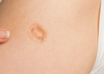 Dit is waarom veel mensen dit litteken op de linkerbovenarm hebben