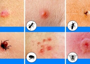 Zo herken je welke beet van welk insect is en wat je eraan kunt doen