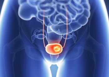 Onderzoek wijst uit: Steeds meer vrouwen met blaaskanker ‘Klachten worden vaak verward met een blaasontsteking’