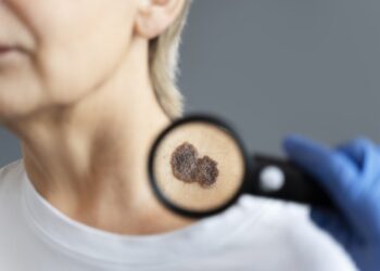 Opgelet: op dit lichaamsdeel komt huidkanker het meeste voor!