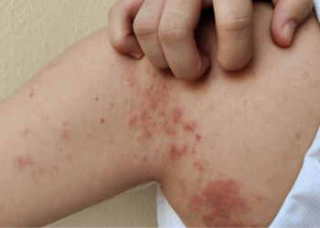 Dit is waarom krentenbaard op dit moment vaak voorkomt (óók bij volwassenen)