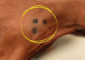 Zie je iemand met drie puntjes op de hand? Dit is waarom je moet oppassen!