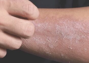 Last van een droge huid? Grote kans dat dit de veroorzaker is