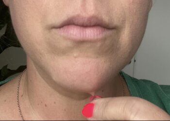 Aha: dit is waarom dat ene kinhaartje steeds terugkomt – en zo kom je er eindelijk van af!