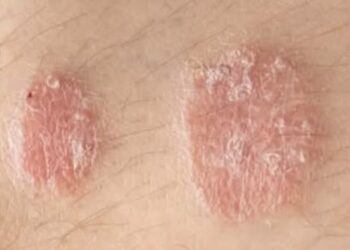 Deze waarschuwingssignalen van je huid die je nooit mag negeren