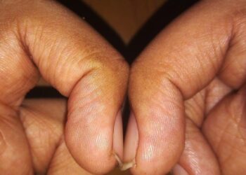 Arts legt uit: Deze test met je vingers laat zien of je een hogere kans op het ontwikkelen van longerkanker hebt