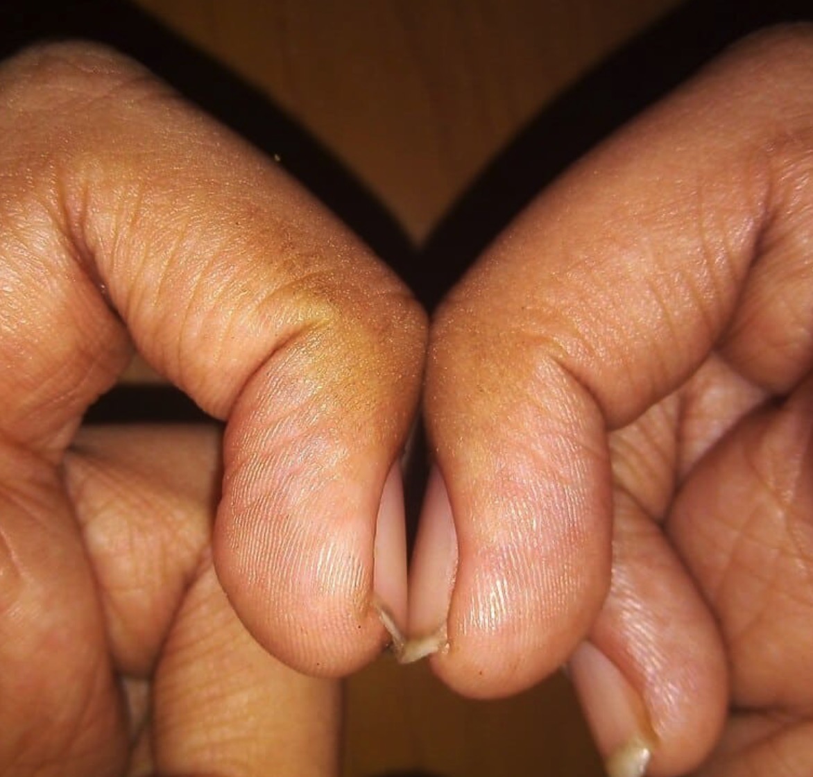 Arts legt uit: Deze test met je vingers laat zien of je een hogere kans op het ontwikkelen van longerkanker hebt