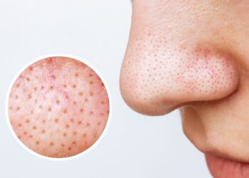 Talgdraadjes: Wat zijn het en waarom zitten ze altijd op je gezicht?