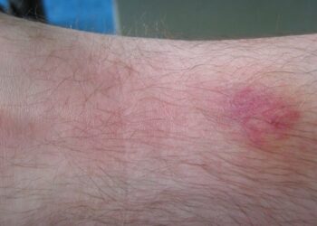 Een dazenbeet? Dit moet je doen bij een beet van deze vlieg