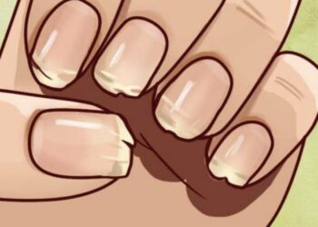 Heb je vaak last van brekende of splijtende nagels? Dit kan veel zeggen over je gezondheid