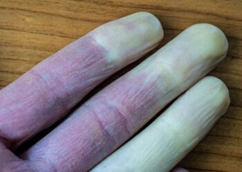 Artsen waarschuwen voor vingers die naar wit, blauw of rode kleur veranderen: dit moet je weten!