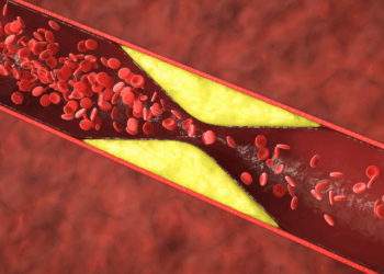 Deze 10 signalen kunnen wijzen op verstopte slagaders (negeer ze niet voordat het te laat is!)