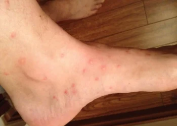 Ontdek oma;s tips voor het behandelen van een vlooienbeet!