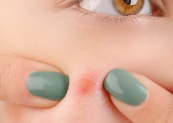 Onderhuidse puist bestrijden en voorkomen met oma;s tips!